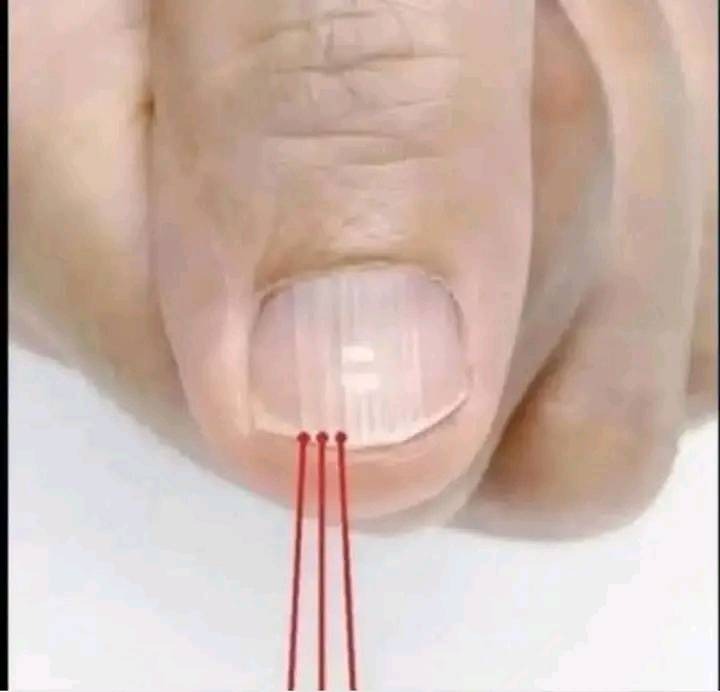 Si tienes rayas en tus uñas significa que tienes can… Ver más